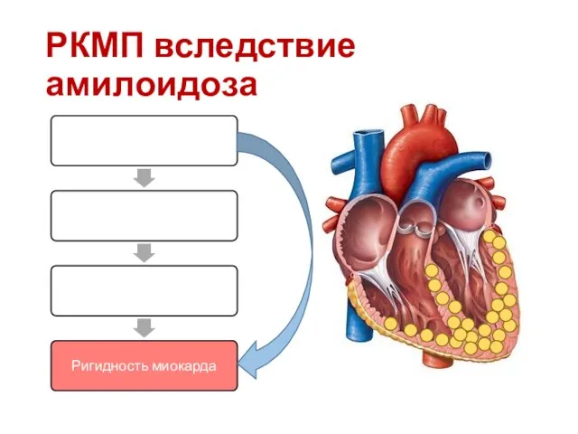 РКМП вследствие амилоидоза