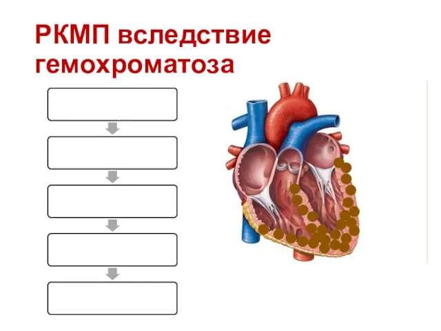 РКМП вследствие гемохроматоза