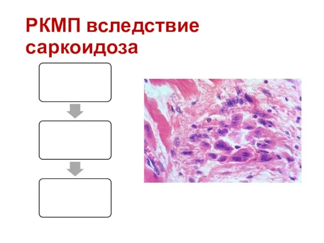 РКМП вследствие саркоидоза