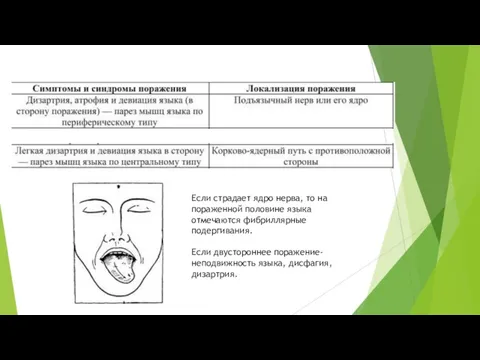 Если страдает ядро нерва, то на пораженной половине языка отмечаются фибриллярные