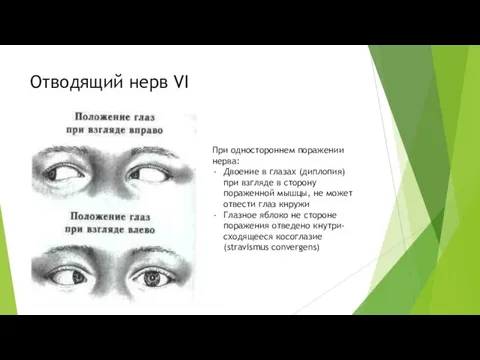 Отводящий нерв VI При одностороннем поражении нерва: Двоение в глазах (диплопия)