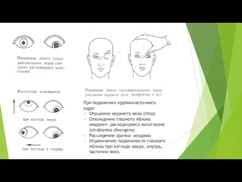 При поражении крупноклеточного ядра: Опущение верхнего века (птоз) Отхождение глазного яблока