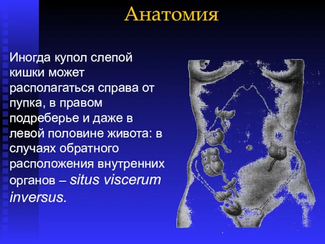 Анатомия Иногда купол слепой кишки может располагаться справа от пупка, в