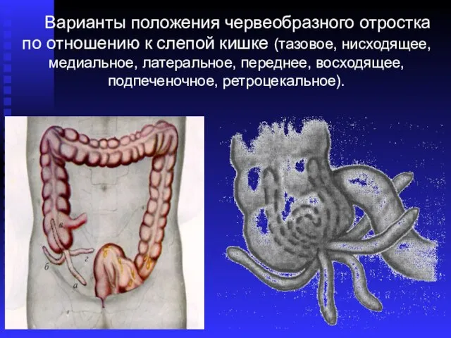 Варианты положения червеобразного отростка по отношению к слепой кишке (тазовое, нисходящее,