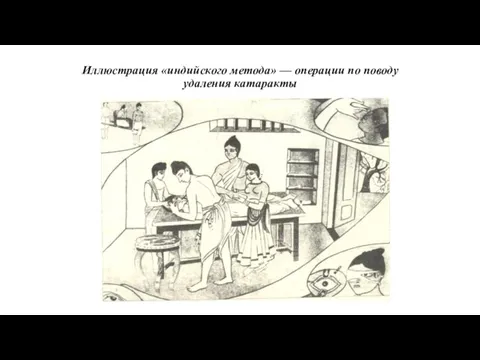 Иллюстрация «индийского метода» — операции по поводу удаления катаракты