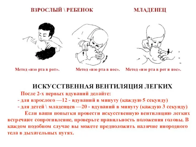 ИСКУССТВЕННАЯ ВЕНТИЛЯЦИЯ ЛЕГКИХ После 2-х первых вдуваний делайте: - для взрослого