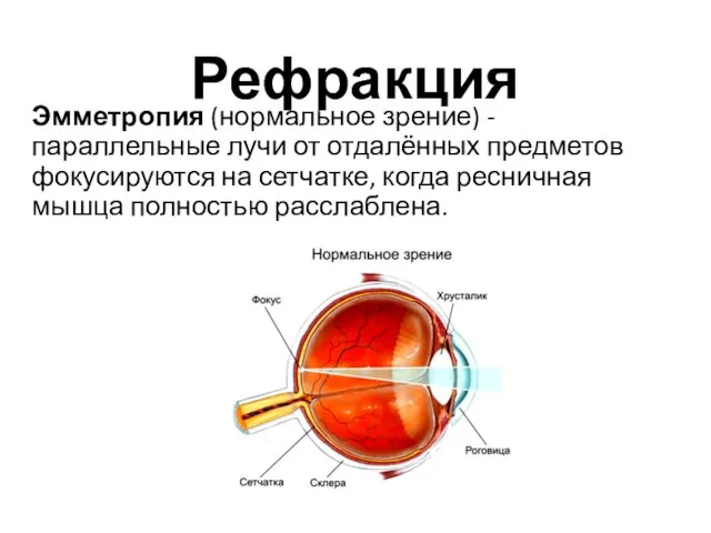 Рефракция Эмметропия (нормальное зрение) - параллельные лучи от отдалённых предметов фокусируются