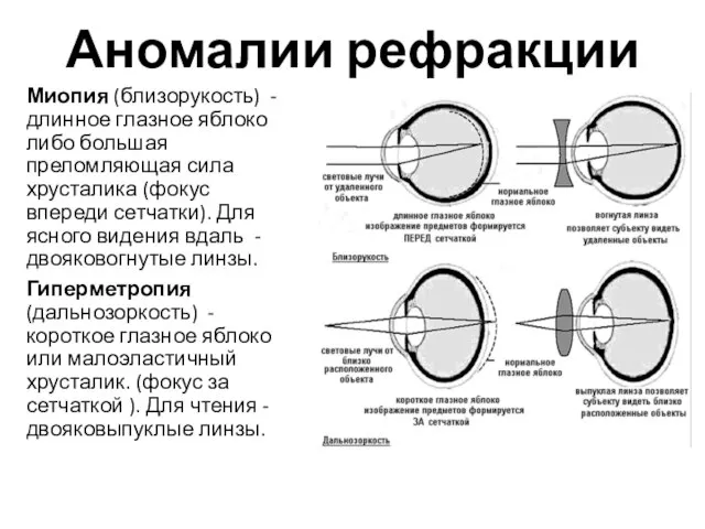 Аномалии рефракции Миопия (близорукость) - длинное глазное яблоко либо большая преломляющая