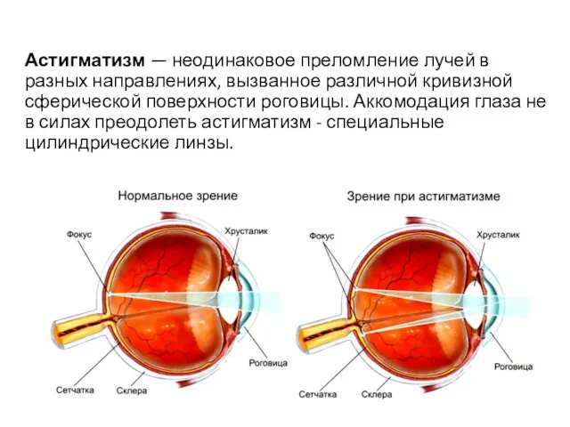 Астигматизм — неодинаковое преломление лучей в разных направлениях, вызванное различной кривизной