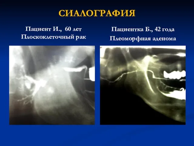 СИАЛОГРАФИЯ Пациент И., 60 лет Плоскоклеточный рак Пациентка Б., 42 года Плеоморфная аденома