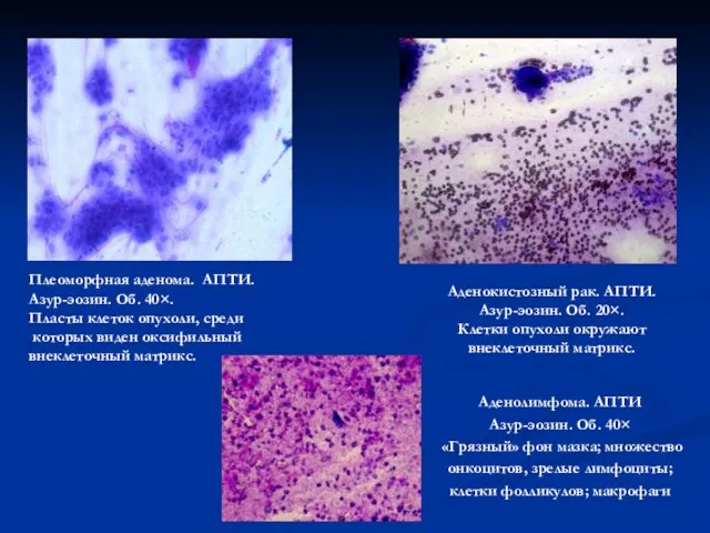Плеоморфная аденома. АПТИ. Азур-эозин. Об. 40×. Пласты клеток опухоли, среди которых