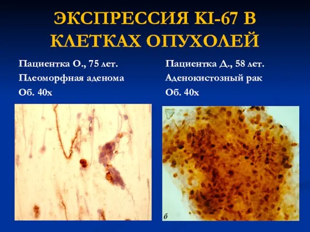 ЭКСПРЕССИЯ KI-67 В КЛЕТКАХ ОПУХОЛЕЙ Пациентка О., 75 лет. Плеоморфная аденома