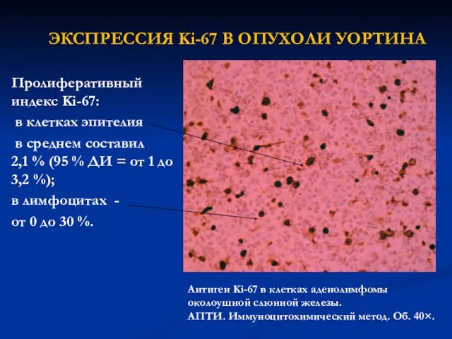 ЭКСПРЕССИЯ Ki-67 В ОПУХОЛИ УОРТИНА Пролиферативный индекс Ki-67: в клетках эпителия