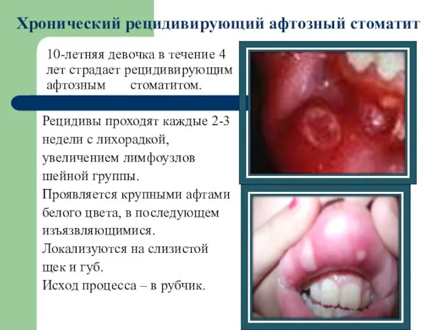 10-летняя девочка в течение 4 лет страдает рецидивирующим афтозным стоматитом. Рецидивы