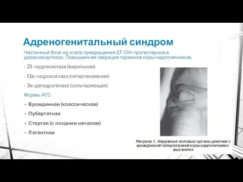 Адреногенитальный синдром Частичный блок на этапе превращения 17-ОН-прогестерона в дезоксикортизол. Повышенная