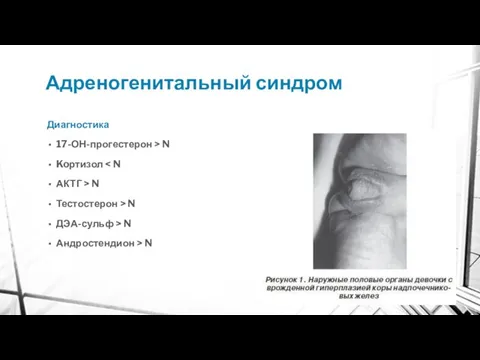 Адреногенитальный синдром Диагностика 17-ОН-прогестерон > N Koртизол АКТГ > N Тестостерон