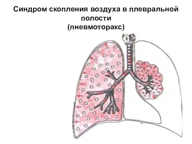 Синдром скопления воздуха в плевральной полости (пневмоторакс)