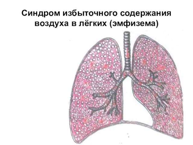 Синдром избыточного содержания воздуха в лёгких (эмфизема)