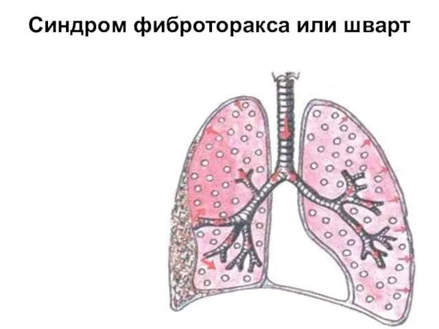 Синдром фиброторакса или шварт