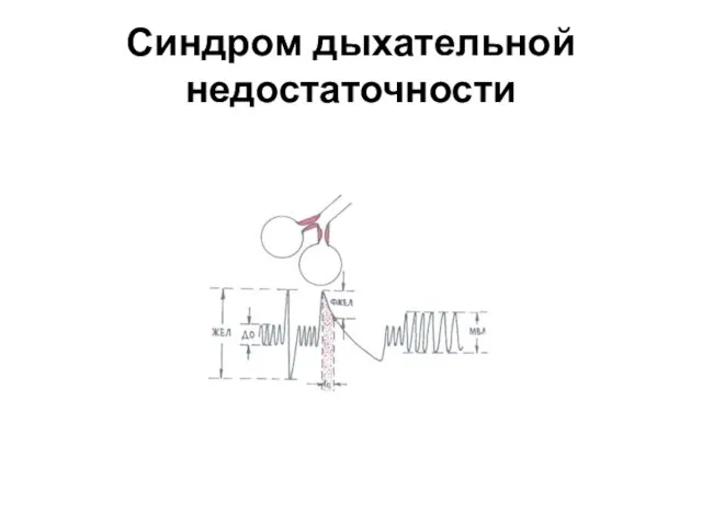 Синдром дыхательной недостаточности