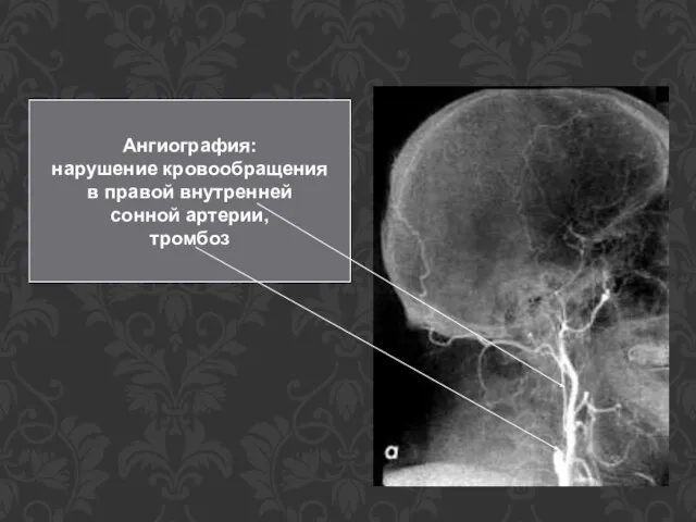 Ангиография: нарушение кровообращения в правой внутренней сонной артерии, тромбоз