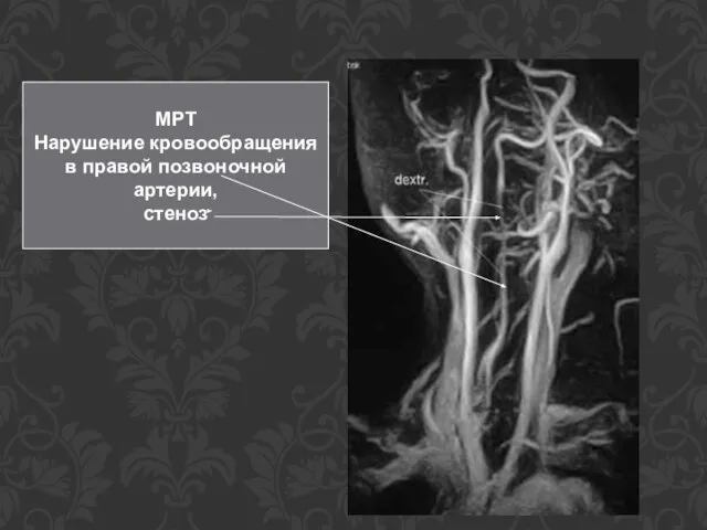 МРТ Нарушение кровообращения в правой позвоночной артерии, стеноз