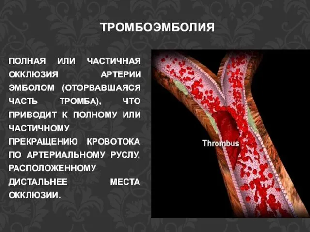 ПОЛНАЯ ИЛИ ЧАСТИЧНАЯ ОККЛЮЗИЯ АРТЕРИИ ЭМБОЛОМ (ОТОРВАВШАЯСЯ ЧАСТЬ ТРОМБА), ЧТО ПРИВОДИТ