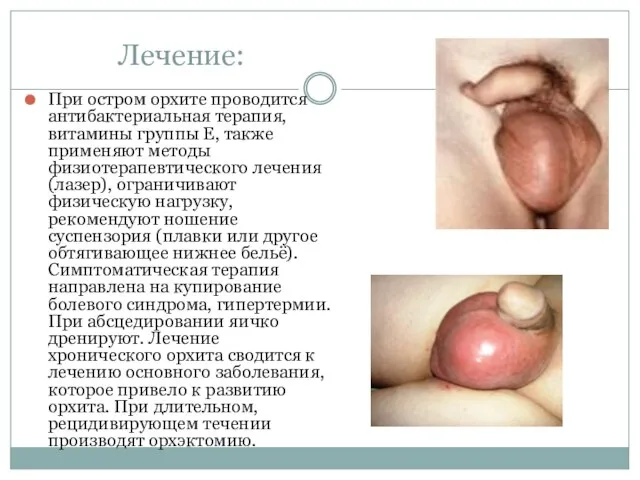 Лечение: При остром орхите проводится антибактериальная терапия, витамины группы E, также