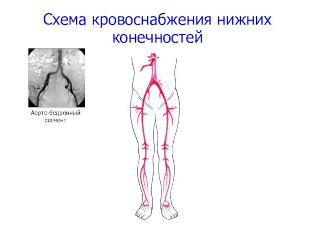 Схема кровоснабжения нижних конечностей Аорто-бедренный сегмент