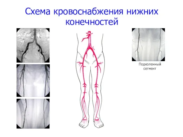 Схема кровоснабжения нижних конечностей Подколенный сегмент