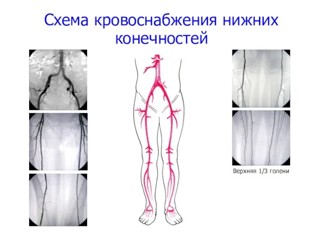 Схема кровоснабжения нижних конечностей Верхняя 1/3 голени