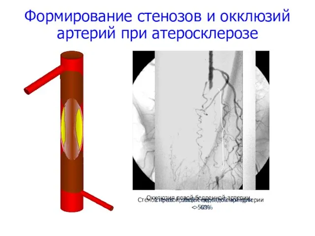 Формирование стенозов и окклюзий артерий при атеросклерозе Стеноз правой общей подвздошной
