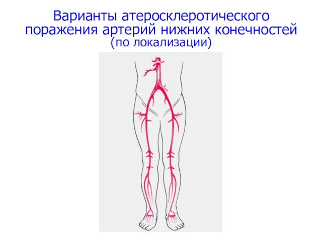 Варианты атеросклеротического поражения артерий нижних конечностей (по локализации)