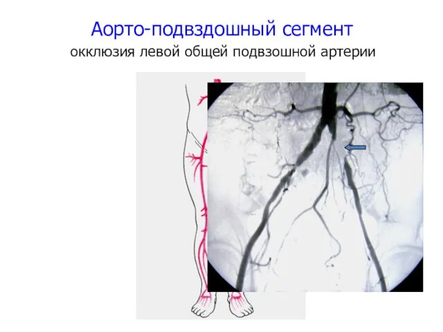 Аорто-подвздошный сегмент окклюзия левой общей подвзошной артерии