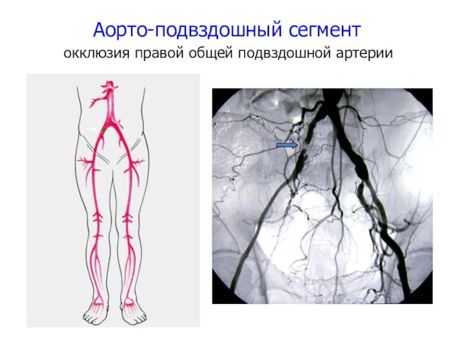 Аорто-подвздошный сегмент окклюзия правой общей подвздошной артерии