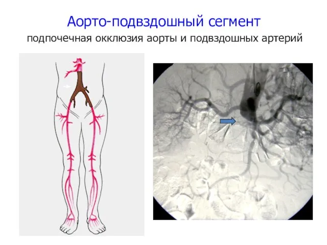 Аорто-подвздошный сегмент подпочечная окклюзия аорты и подвздошных артерий