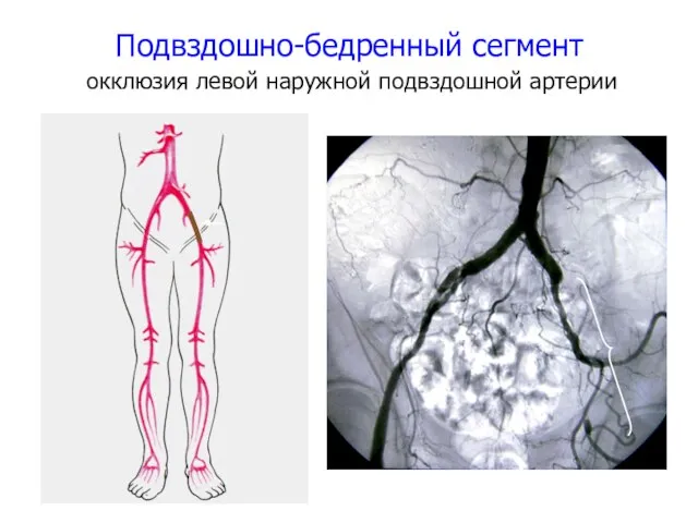 Подвздошно-бедренный сегмент окклюзия левой наружной подвздошной артерии