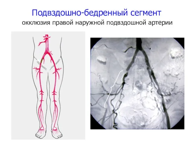 Подвздошно-бедренный сегмент окклюзия правой наружной подвздошной артерии