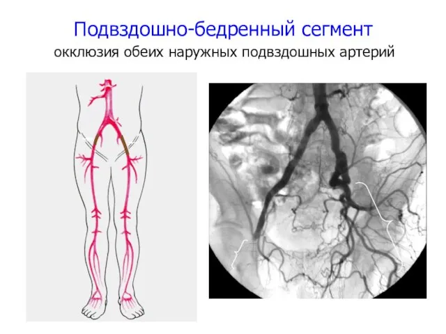 Подвздошно-бедренный сегмент окклюзия обеих наружных подвздошных артерий