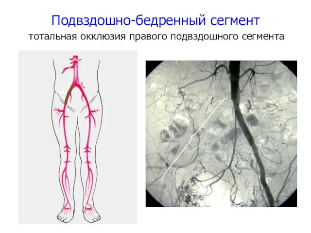 Подвздошно-бедренный сегмент тотальная окклюзия правого подвздошного сегмента