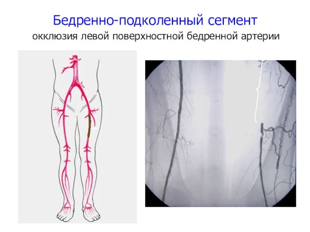 Бедренно-подколенный сегмент окклюзия левой поверхностной бедренной артерии