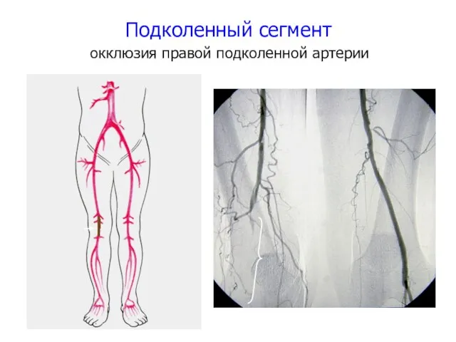 Подколенный сегмент окклюзия правой подколенной артерии