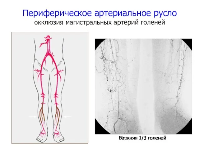 Периферическое артериальное русло окклюзия магистральных артерий голеней Верхняя 1/3 голеней Нижняя 1/3 голеней