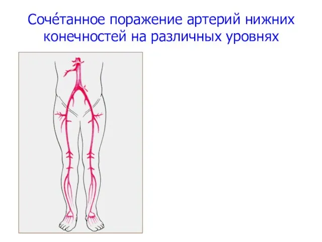 Сочéтанное поражение артерий нижних конечностей на различных уровнях