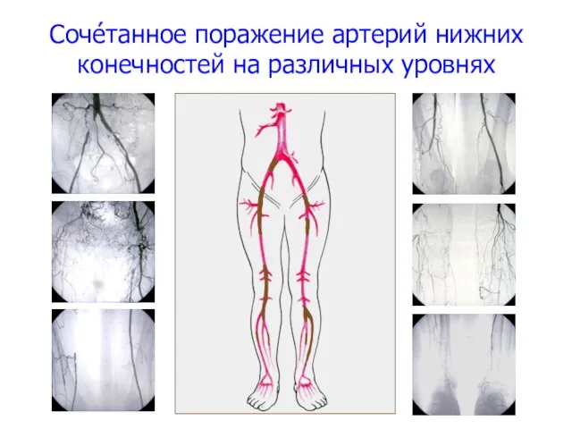 Сочéтанное поражение артерий нижних конечностей на различных уровнях