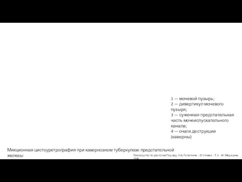 Микционная цистоуретрография при кавернозном туберкулезе предстательной железы 1 — мочевой пузырь;