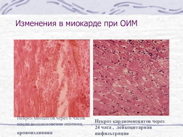 Изменения в миокарде при ОИМ Некроз миоцитов через 6 часов после