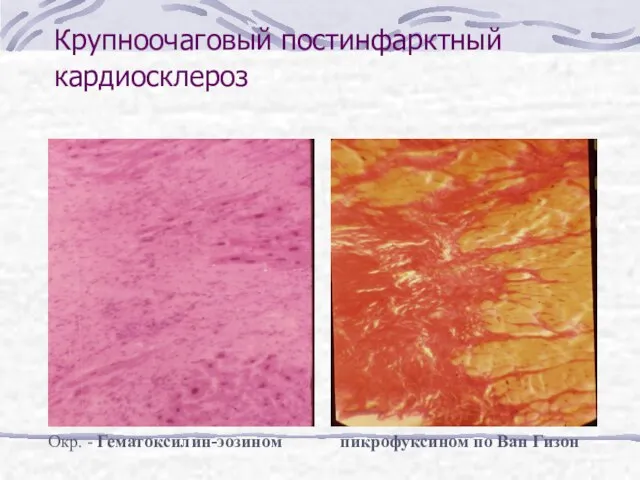 Крупноочаговый постинфарктный кардиосклероз Окр. - Гематоксилин-эозином пикрофуксином по Ван Гизон