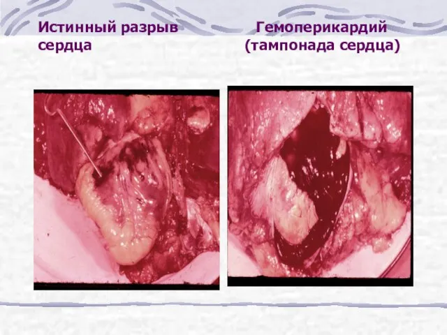 Истинный разрыв Гемоперикардий сердца (тампонада сердца)