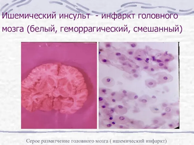 Ишемический инсульт - инфаркт головного мозга (белый, геморрагический, смешанный) Серое размягчение головного мозга ( ишемический инфаркт)